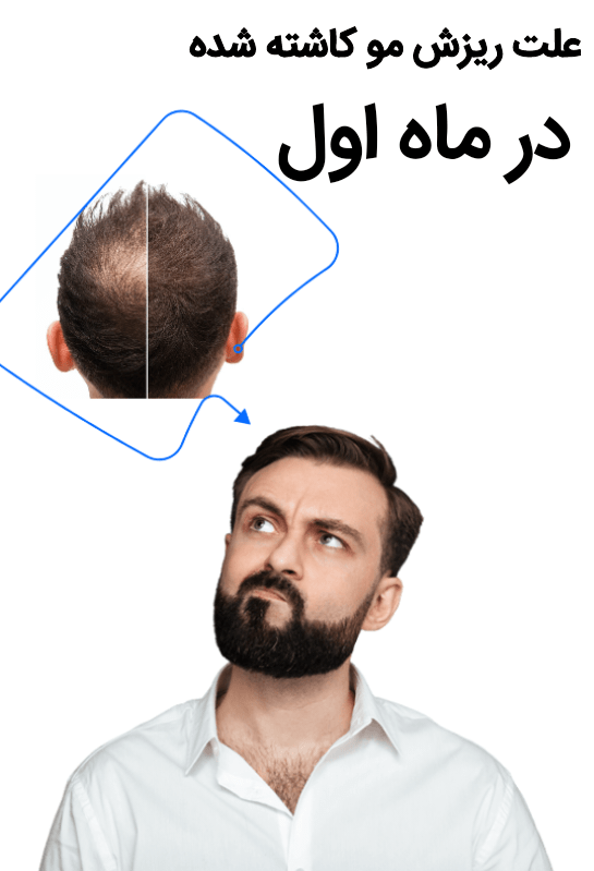 علت ریزش موهای کاشته‌شده در ماه اول چیست؟  + دستورالعمل